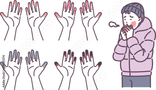 illustration of a person with frostbite on his hand