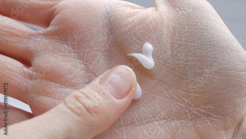 Using hand cream for dry skin close-up moisturizing palms and treating dermatitis with cream dermatology and cosmetology, skin care and dry skin treatment concept evidence-based medicine photo