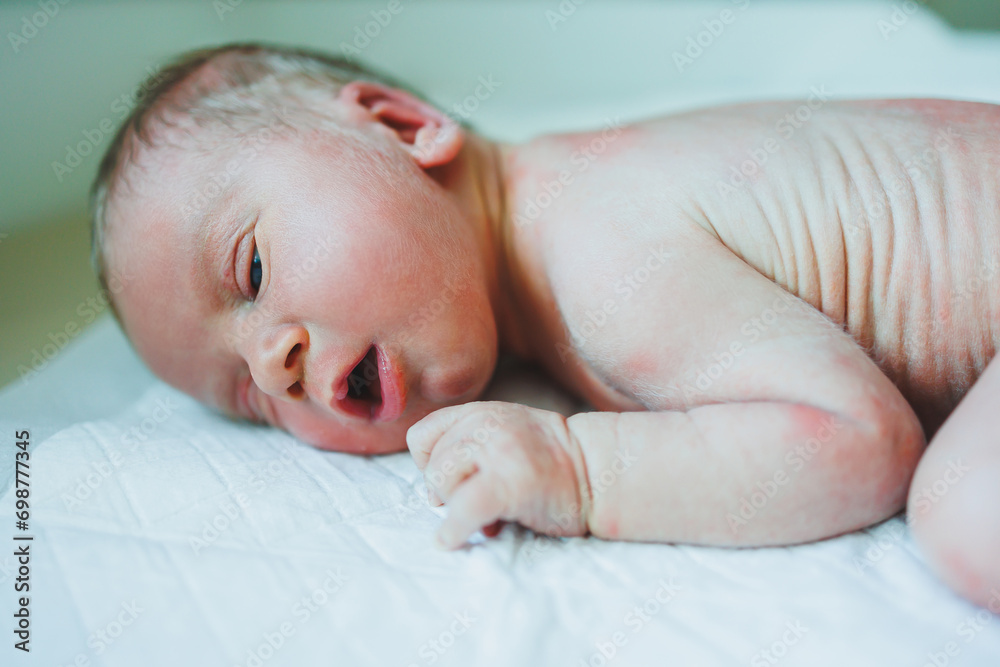 A newborn baby is lying on a diaper with a red rash on his body