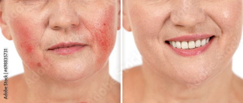Before and after rosacea treatment. Photos of woman on white background, closeup. Collage showing affected and healthy skin