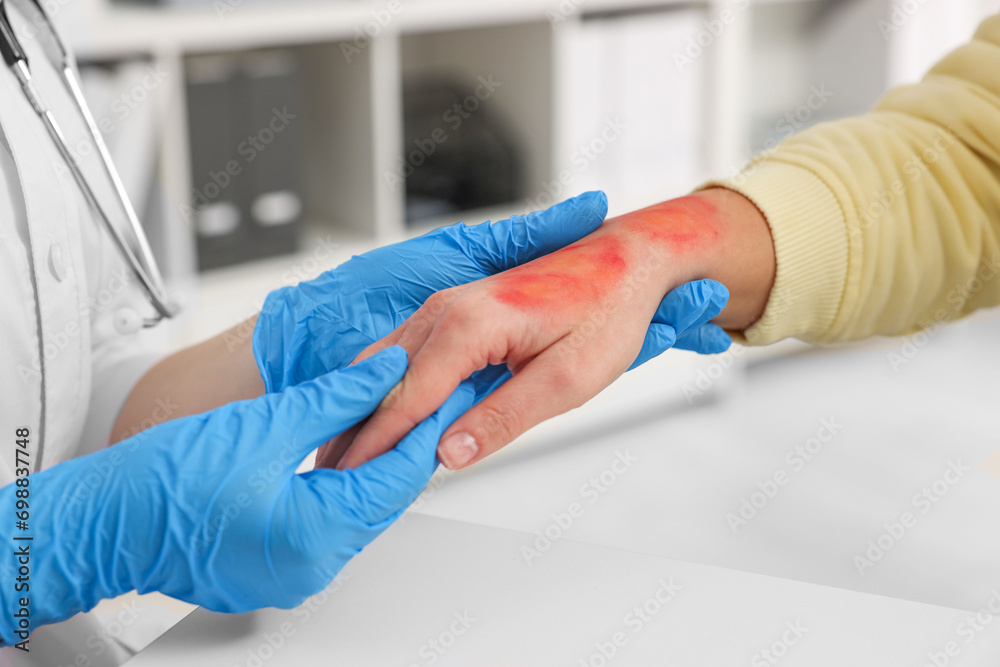 Obraz premium Doctor examining patient's burned hand indoors, closeup