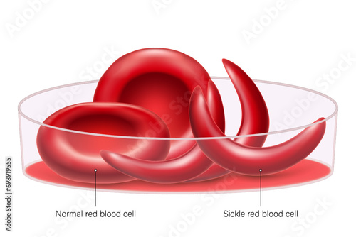 Sickle cell disease vector. Sickle cell anemia. Normal and sickle shaped red blood cells. photo