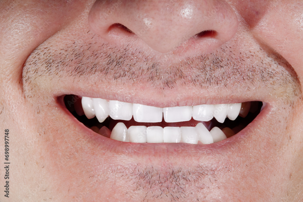 Obraz premium Close Up of a Man's Smile After Teeth Whitening and Ceramic Veeneers Restoration For Perfect Natural Smile. Dental Сare and Stomatology