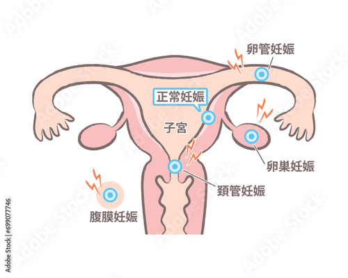 子宮外妊娠　子宮のイラスト図　卵管、卵巣、頚管、腹膜 photo