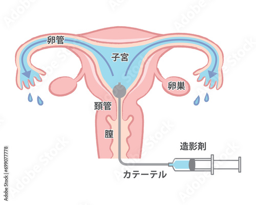 卵管造影 卵管の通りが良い子宮のイラスト　説明図　文字あり