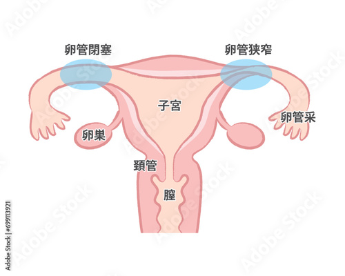 卵管閉塞 卵管狭窄　卵管のつまり　子宮のイラスト説明図