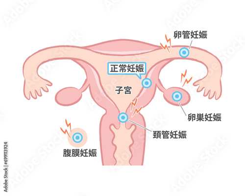 子宮外妊娠　子宮のイラスト図　卵管、卵巣、頚管、腹膜 photo