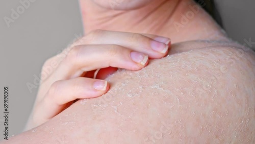 Peeling shoulder skin due to dehydration close up side view effects of dehydration on shoulder skin personal hygiene and medicine self care, concept of dehydration dermatitis and dry skin