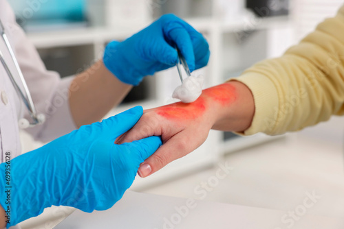 Doctor treating patient's burned hand in hospital, closeup