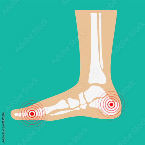 Human leg pain zones. Design elements for infographic. Vector illustration.