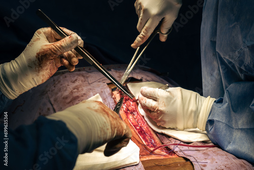 Close up of surgeons hands with scalpel at operation in operating room at hospital