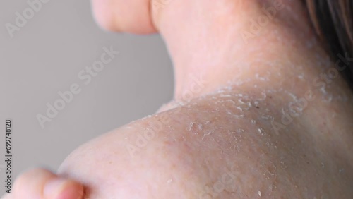Peeling skin on shoulder due to dehydration close-up rear view effect of dehydration on skin dermatology and cosmetology, concept of dehydration and peeling of skin problems with skin photo