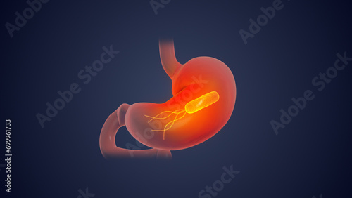 Helicobacter pylori in human stomach	 photo