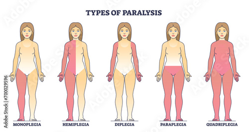 Types of paralysis and limb body parts as medical condition outline diagram. Labeled educational scheme with monoplegia, hemiplegia, diplegia and paraplegia disorder differences vector illustration.