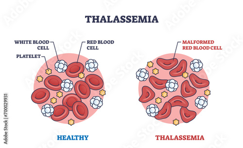 Thalassemia blood disorder caused by lack of hemoglobin outline diagram. Labeled educational scheme with healthy red blood cells vs malformed vector illustration. Microbiological disorder explanation