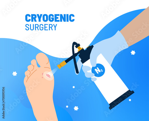 Targeted cryotherapy procedure for mole on foot. Medical instrument with liquid nitrogen freezing a tumor on a sole. Painless cryogenic surgery for skin treatments.
