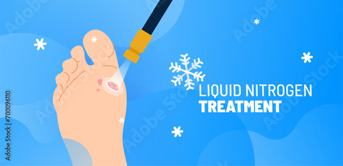 Targeted cryotherapy procedure for tumor on foot. Medical instrument with liquid nitrogen freezing a wart on a sole. Painless cryogenic surgery for skin treatments.