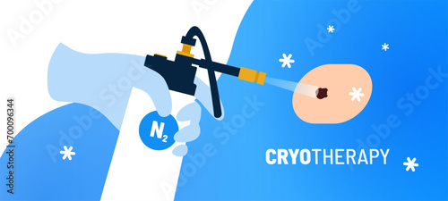 Targeted cryotherapy procedure for mole on skin. Medical instrument liquid nitrogen in doctors hand. Cryogenic precision for improved health. Minimally invasive cryotherapy for tumor removal.