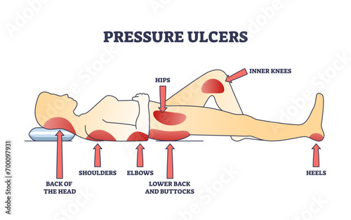 Pressure ulcers or bedsores skin tissue injuries locations outline diagram. Labeled educational scheme with stationary laying patient caused dermatological conditions on body vector illustration. photo