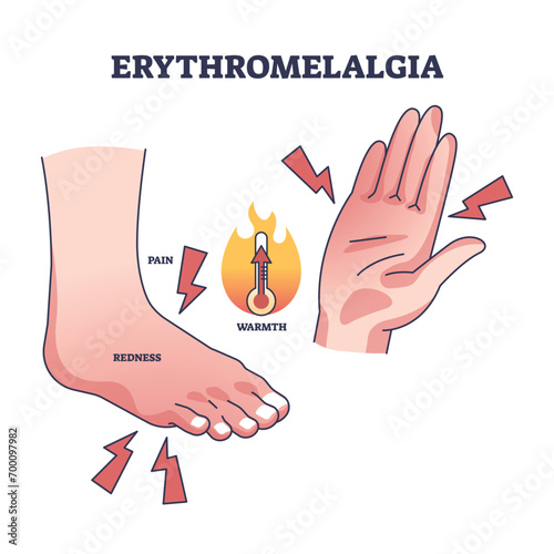 Erythromelalgia syndrome caused redness, pain or warmth outline diagram. Labeled educational scheme with foot, palm or hands burning sensations from red blood cells overproduction vector illustration