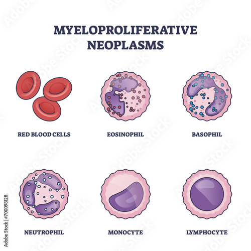 Myeloproliferative neoplasms as bone marrow blood diseases outline diagram. Labeled educational scheme with medical eosinophil, basophil, neutrophil, monocyte and lymphocyte list vector illustration.
