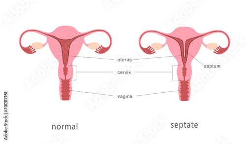 Septate and normal human uterus structure. Uterine septum as a congenital uterine malformation. Anatomy chart. Vector illustration