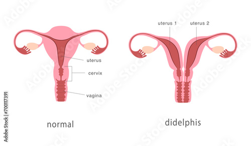 Didelphis and normal human uterus structure. Uterine deep septum as a congenital uterine malformation. Anatomy chart. Vector illustration photo