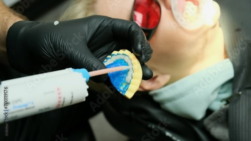 Dentist applies adhesive mixture to denture mold. Orthodontist treatment in dentistry, dental prosthodontics prosthetics. Taking impressions to create veneers. photo