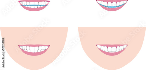 笑顔の歯列の見え方ベクターイラスト。スマイルラインのカーブとストレートライン