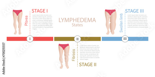 Different stages of leg lymphedema