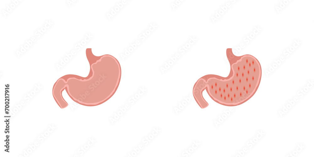 Obraz premium Gastroenteritis Disease Scientific Design. Vector Illustration.