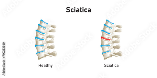 Sciatica Disease Scientific Design. Vector Illustration.