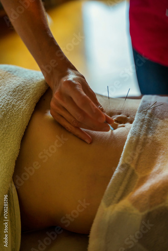 Obraz na płótnie Young woman undergoing acupuncture treatment on her stomach, close up w salonie