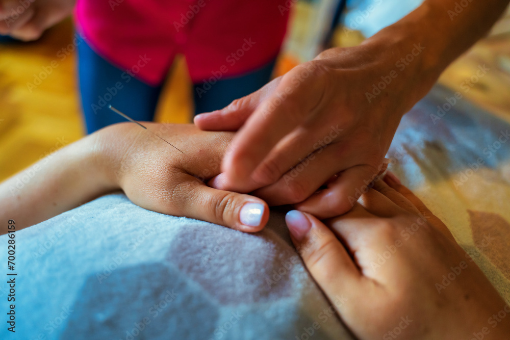 Acupuncture treatment on patient hand. Needles on hand