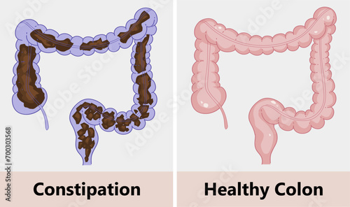 Constipation, healthy colon. Intestinal obstruction, intestinal cleansing. Before after. Healthcare illustration. Vector illustration. 