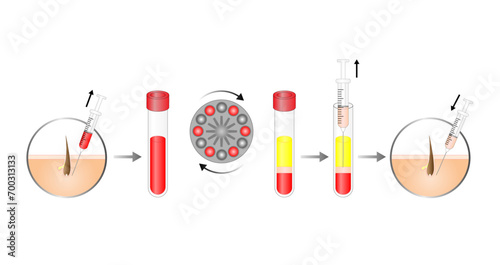 Platelet-rich plasma (prp). Autologous conditioned plasma, is a concentrate of PRP extracted from whole blood. After centrifugation, extract PRP and inject skin or hair. Vector Illustration.