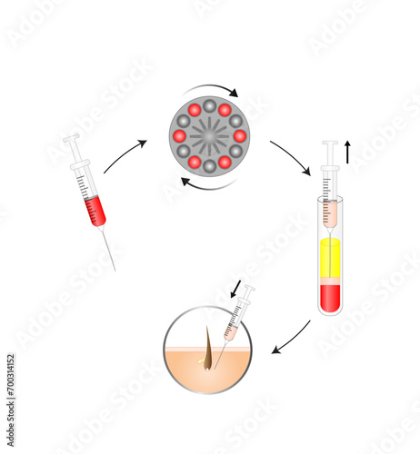Platelet-rich plasma (prp). Autologous conditioned plasma, is a concentrate of PRP extracted from whole blood. After centrifugation, extract PRP and inject skin or hair. Vector Illustration.