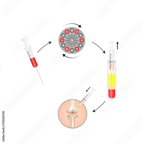 Platelet-rich plasma (prp). Autologous conditioned plasma, is a concentrate of PRP extracted from whole blood. After centrifugation, extract PRP and inject knee. Vector Illustration. photo