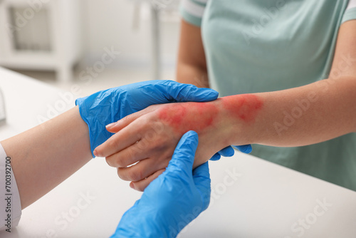 Doctor examining patient s burned hand indoors  closeup