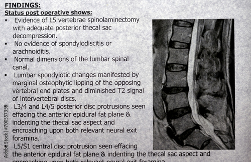 Slika na platnu MRI lumbosacral spine shows L5 Vertebrae Spinal laminectomy evidence, posterior