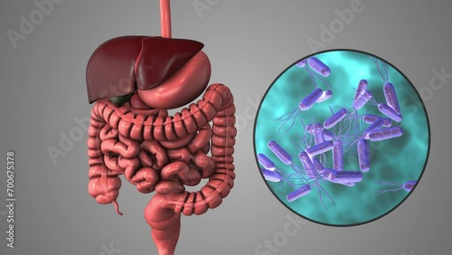 Helicobacter pylori infection of the stomach photo