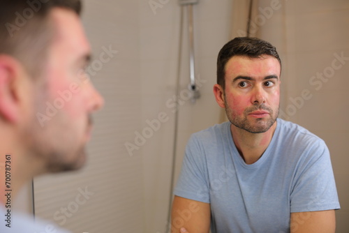 Obraz na plátně Man with severe allergic reaction on facial skin
