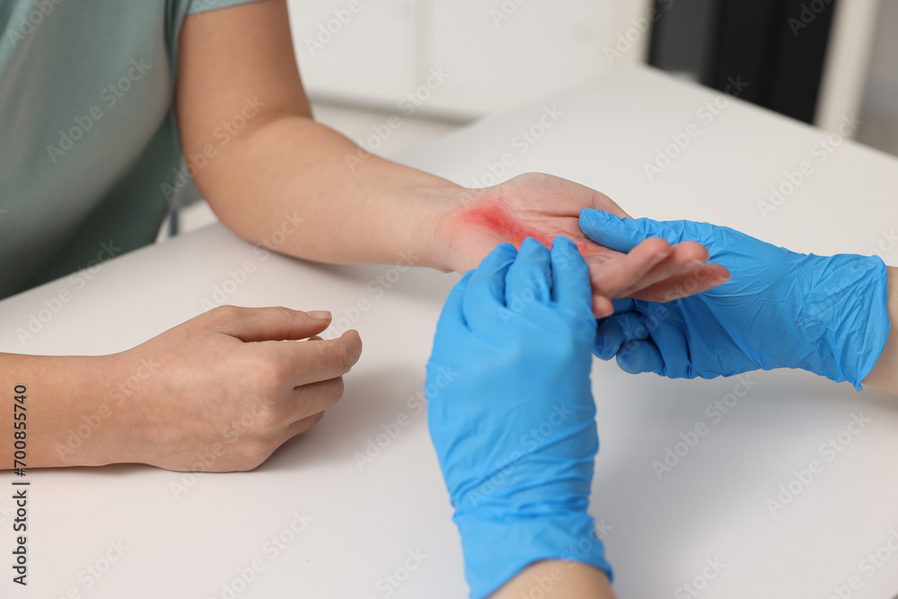 Doctor examining patient's burned hand indoors, closeup
