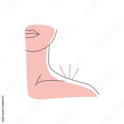 Person undergoing acupuncture on white background