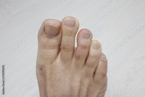 cold hands and feet