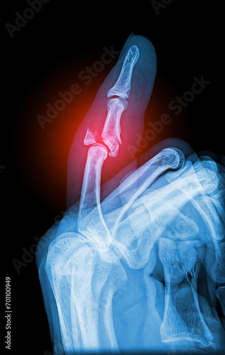 Quadro em tela Real X-ray scan - broken finger side view