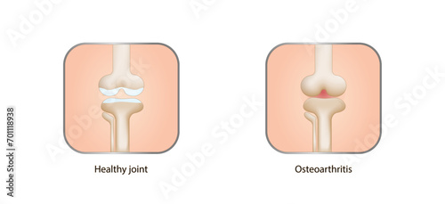 Osteoarthritis. Healthy and Arthritis knee joint. Knee pain. Vector illustration.