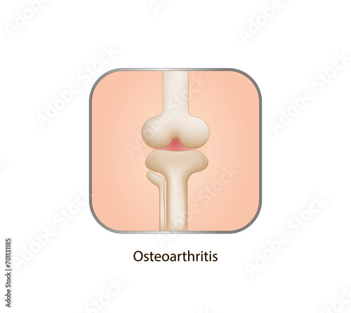 Osteoarthritis. Arthritis knee joint. Knee pain. Vector illustration.