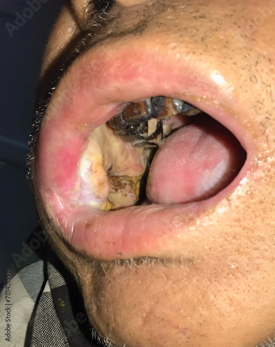 A painless chronic ulcer in the inner surface of cheek. Oral cancer. photo