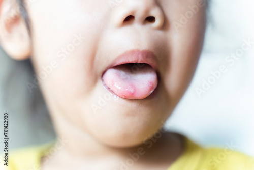 Hand-foot-and-mouth disease or HFMD, is caused by a virus. Close up of a infected wollen tongue with blisters. photo
